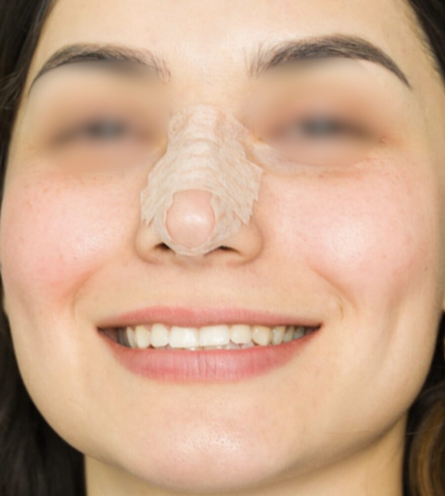 Rhinoplasty in Okinawa | 那覇市の美容クリニック MSA美容外科