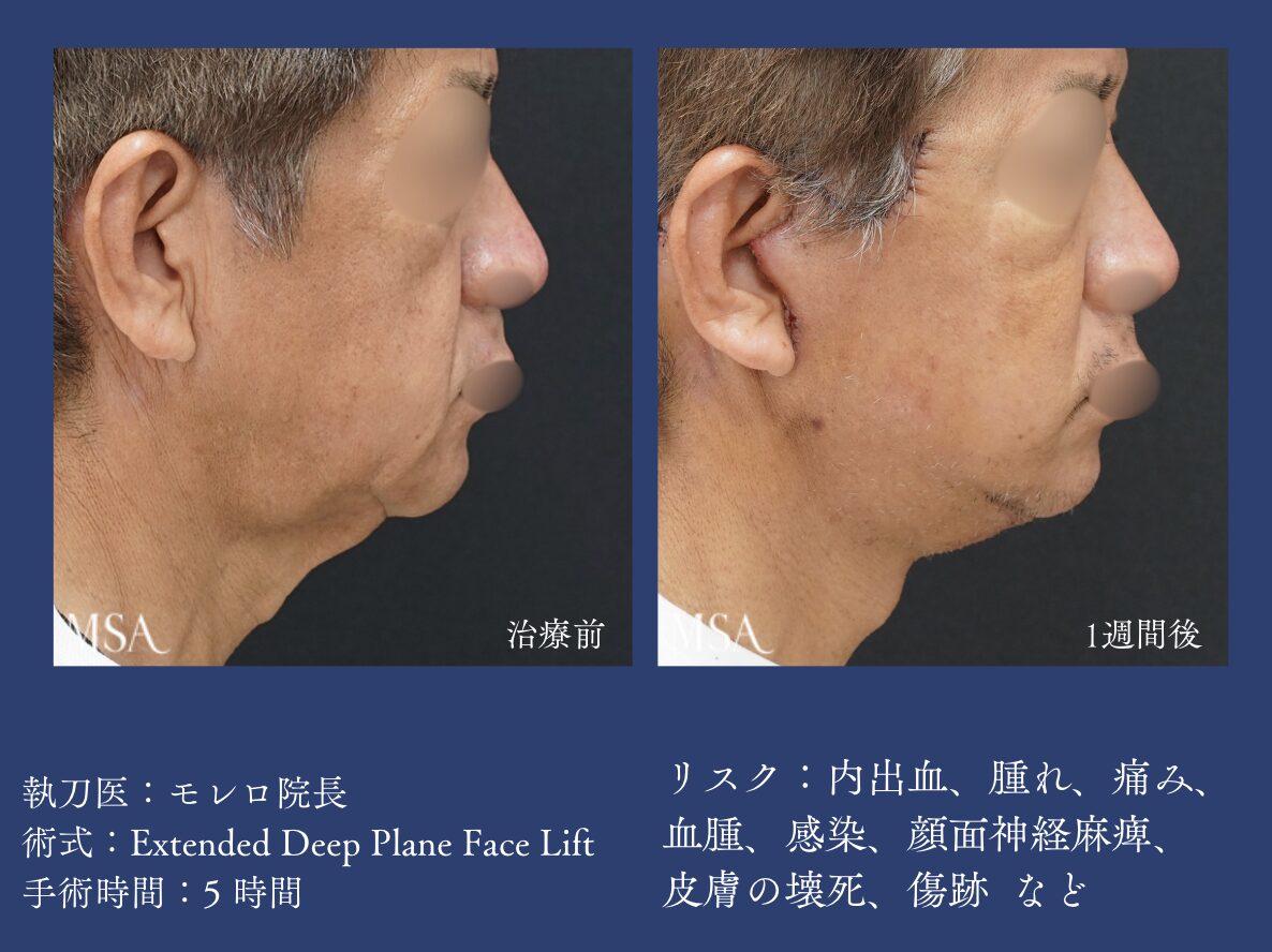 男性のフェイスリフト需要が広がっています | 那覇市の美容クリニック